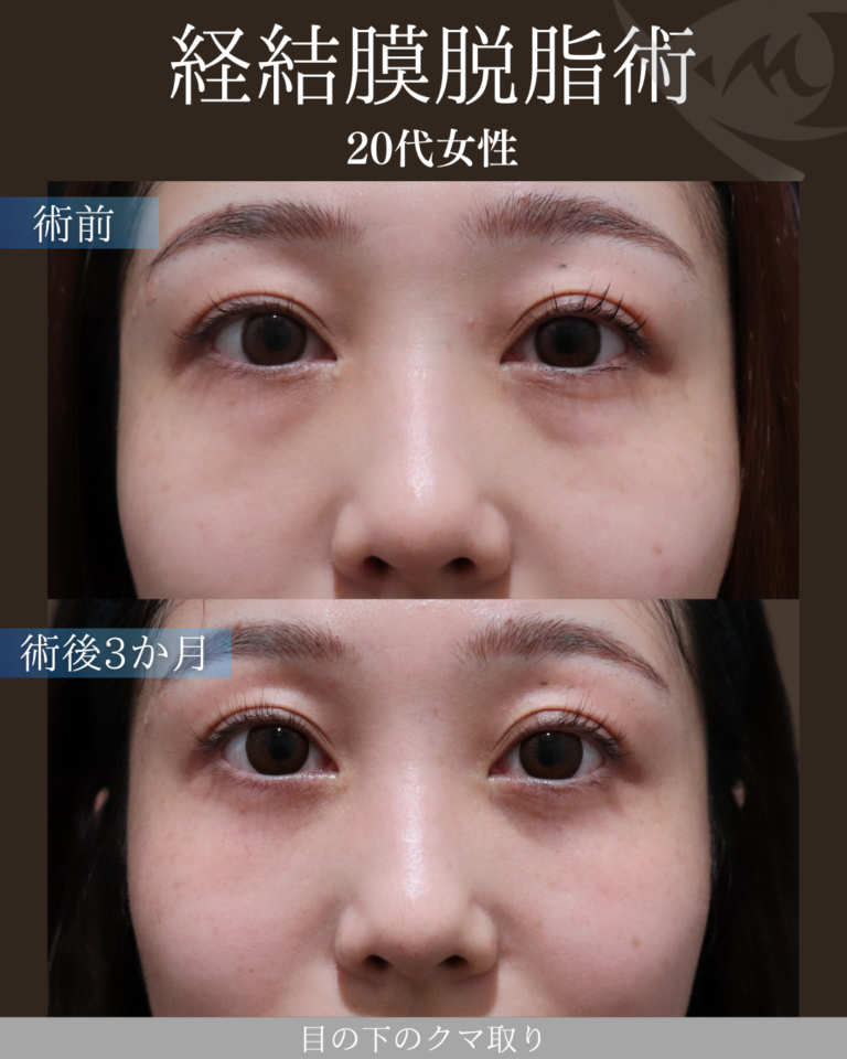 20代女性 経結膜脱脂術 術後3ヶ月